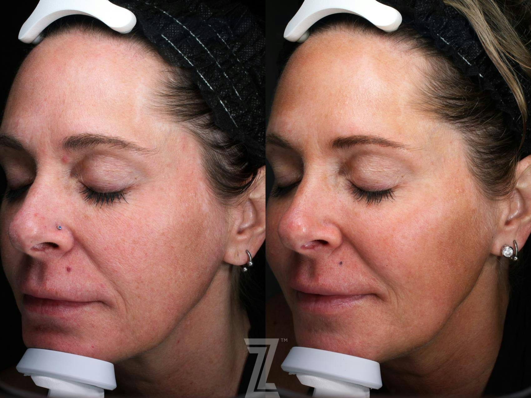 Visia Skincare Analysis Before & After Gallery - Patient 132963268 - Image 2