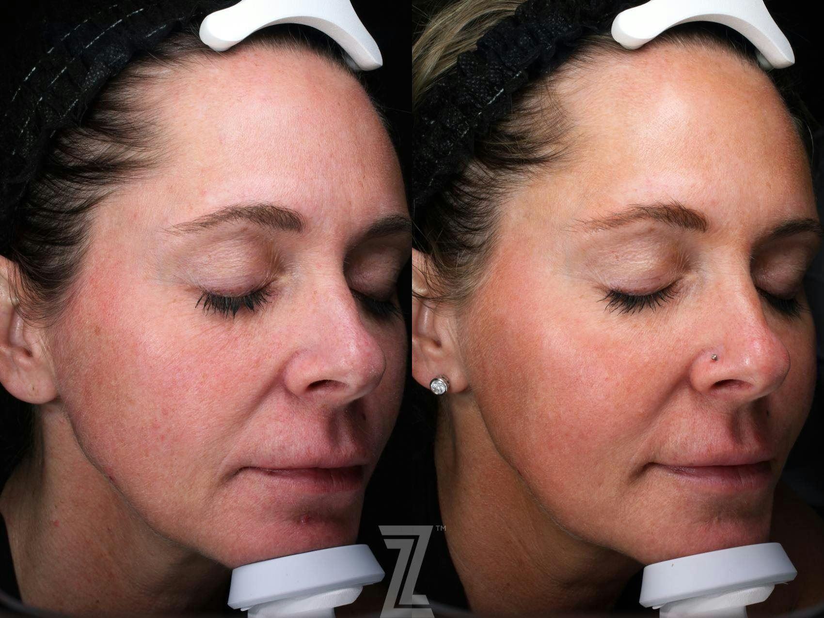 Visia Skincare Analysis Before & After Gallery - Patient 132963268 - Image 3