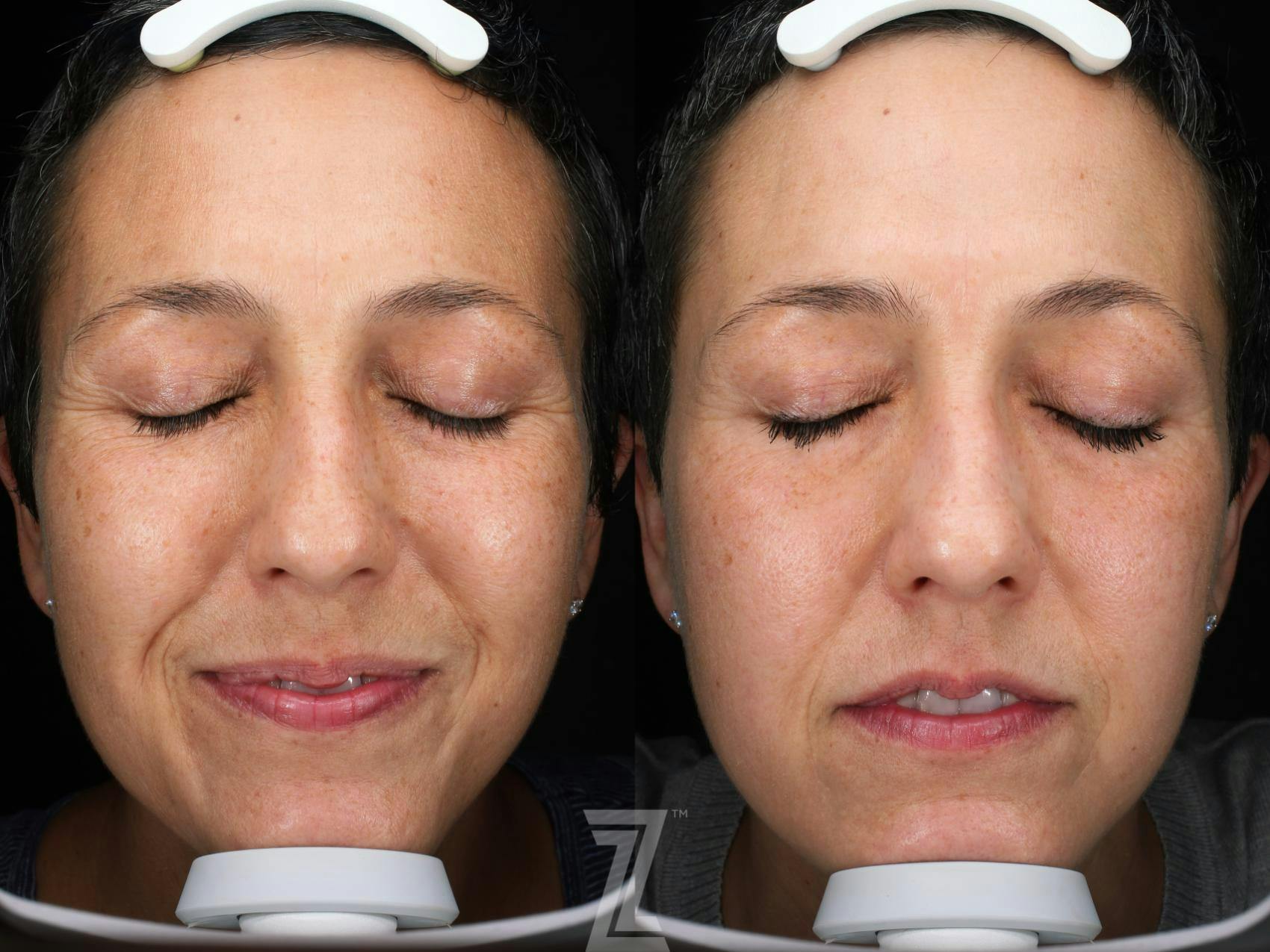 Visia Skincare Analysis Before & After Gallery - Patient 132963273 - Image 1