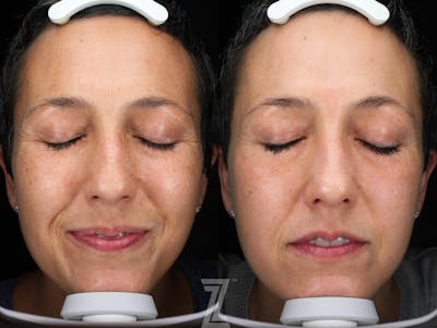 Austin Visia Skincare Analysis Before & After Gallery - Patient 132963273 - Image 1 - The Piazza Center
