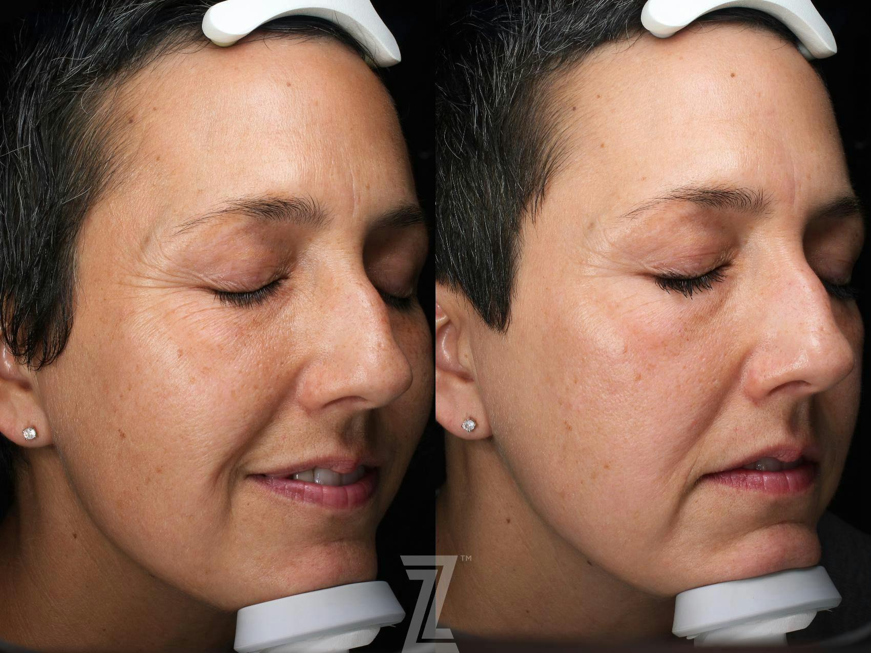 Visia Skincare Analysis Before & After Gallery - Patient 132963273 - Image 2