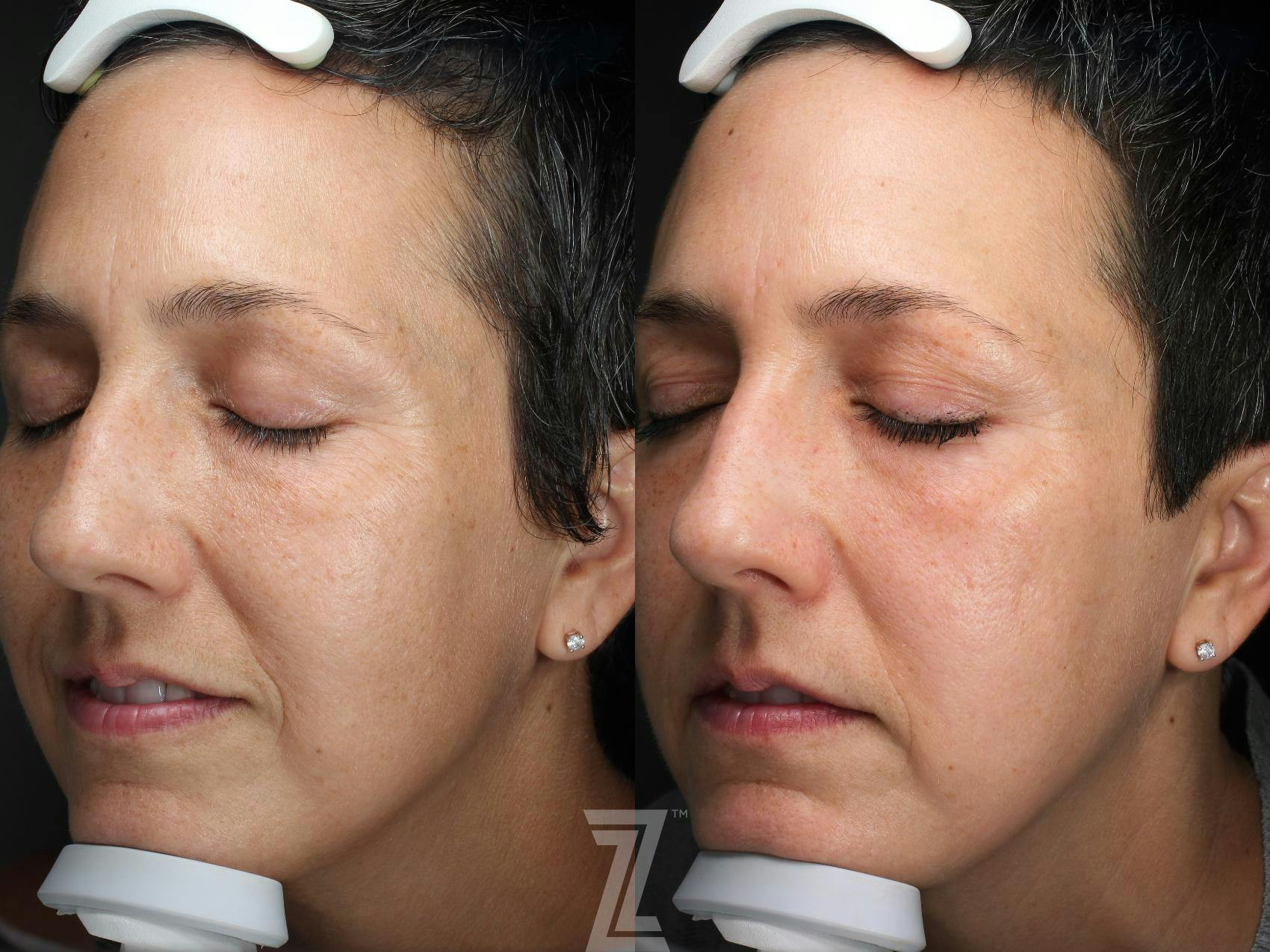 Visia Skincare Analysis Before & After Gallery - Patient 132963273 - Image 3
