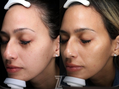 Visia Skincare Analysis Before & After Gallery - Patient 132963276 - Image 1