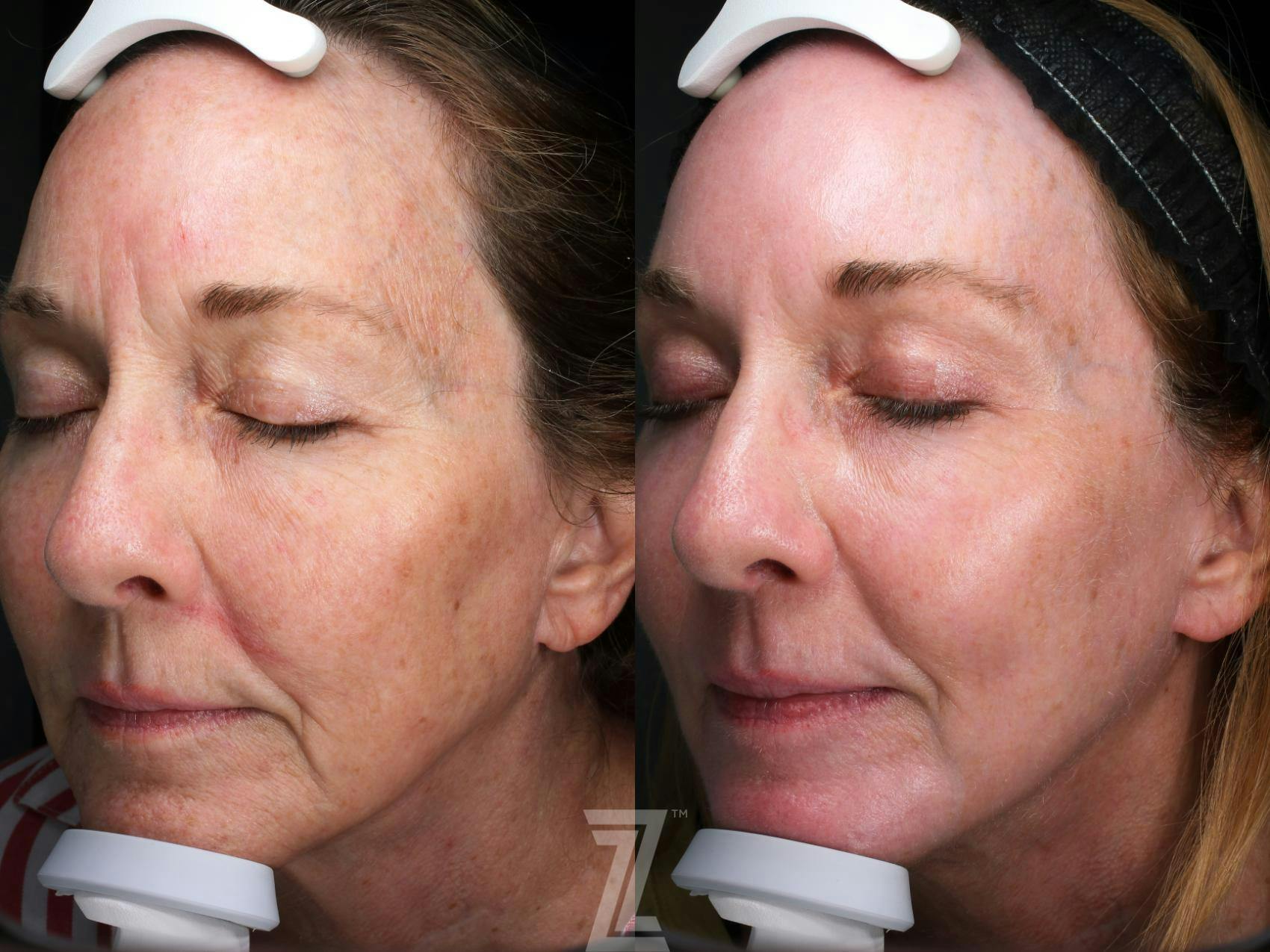 Visia Skincare Analysis Before & After Gallery - Patient 132963279 - Image 1