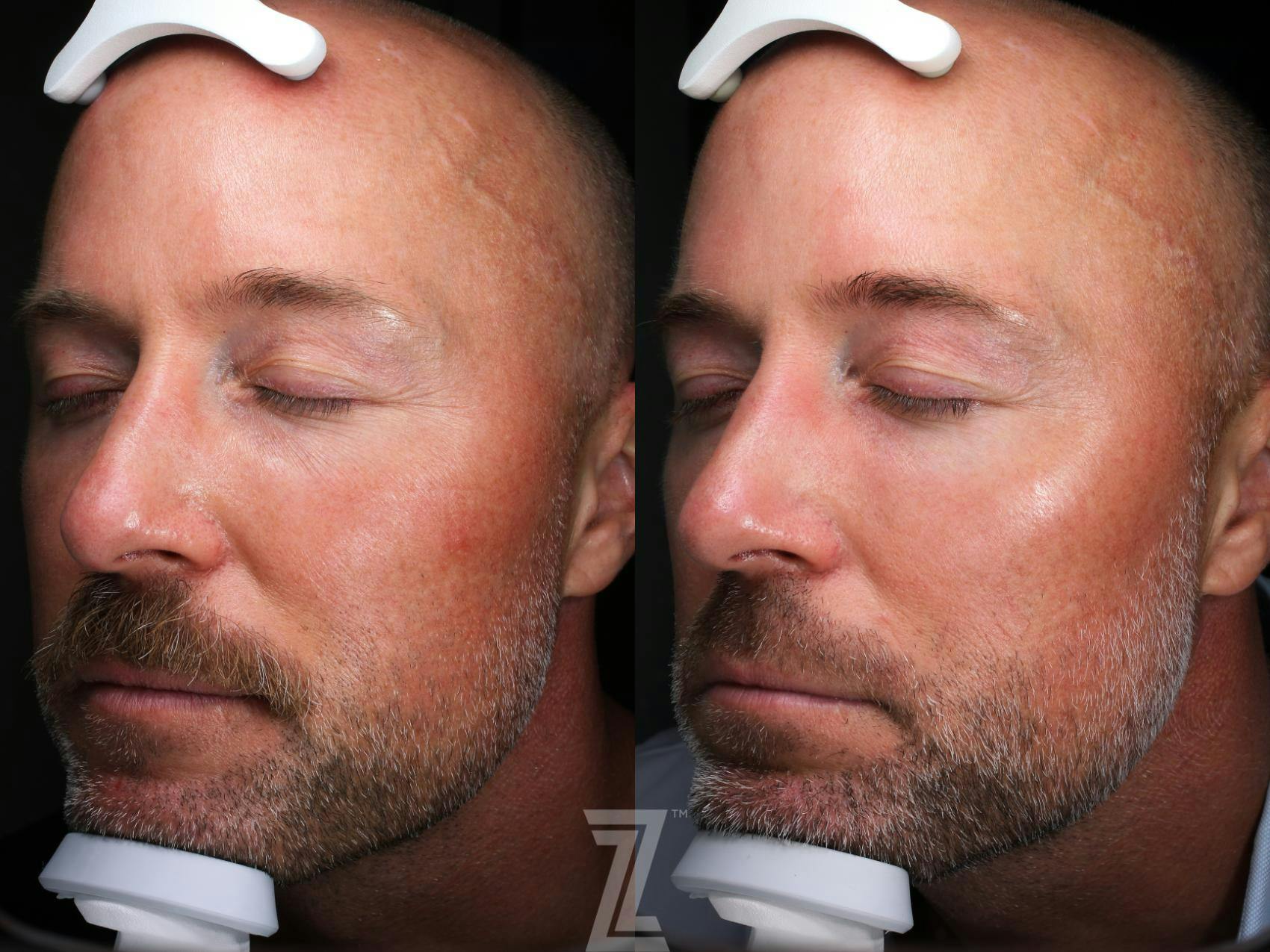 Visia Skincare Analysis Before & After Gallery - Patient 132963282 - Image 1