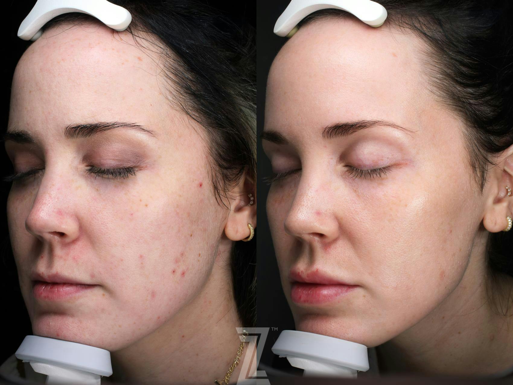 Visia Skincare Analysis Before & After Gallery - Patient 132963285 - Image 1