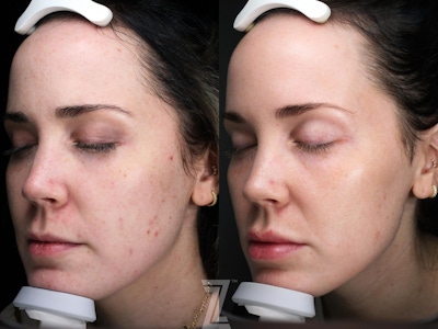 Visia Skincare Analysis Before & After Gallery - Patient 132963285 - Image 1