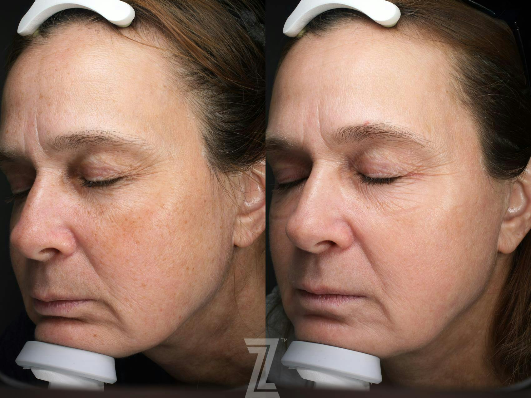 Visia Skincare Analysis Before & After Gallery - Patient 132963287 - Image 1