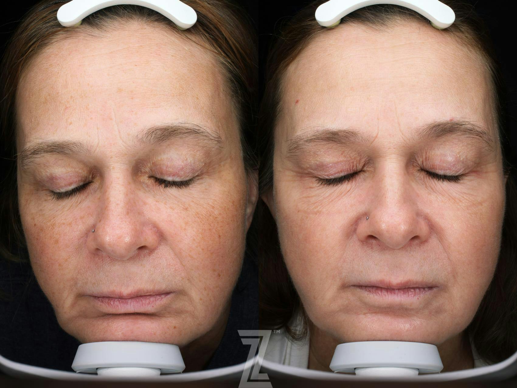 Visia Skincare Analysis Before & After Gallery - Patient 132963287 - Image 2