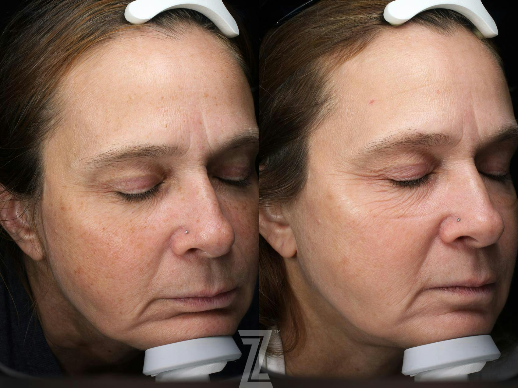 Visia Skincare Analysis Before & After Gallery - Patient 132963287 - Image 3
