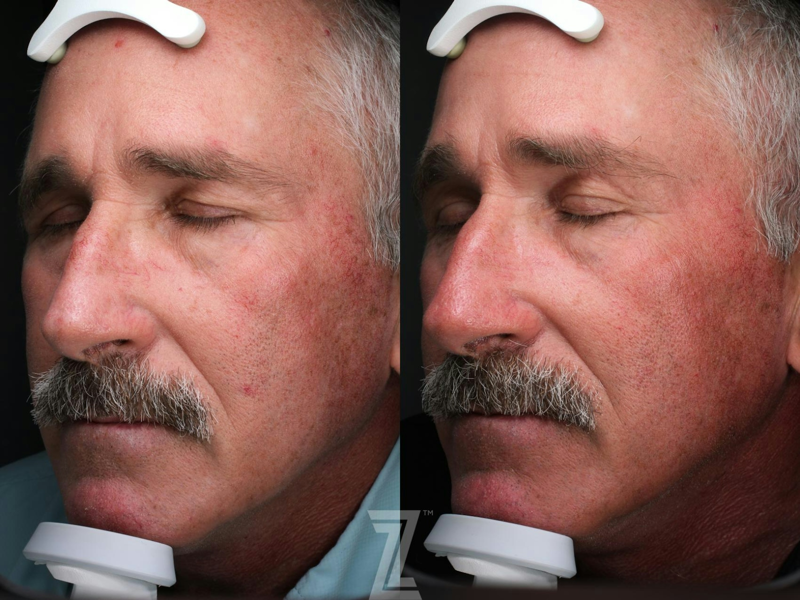 Austin BBL Before & After Gallery - Patient 228306 - Image 1 - The Piazza Center