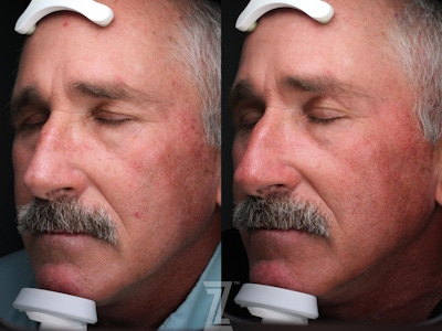 Visia Skincare Analysis Before & After Gallery - Patient 132963291 - Image 1