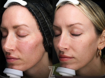 Visia Skincare Analysis Before & After Gallery - Patient 132963296 - Image 1