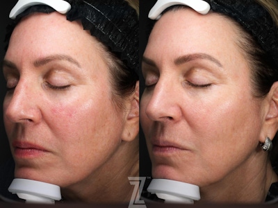 Visia Skincare Analysis Before & After Gallery - Patient 132963566 - Image 1