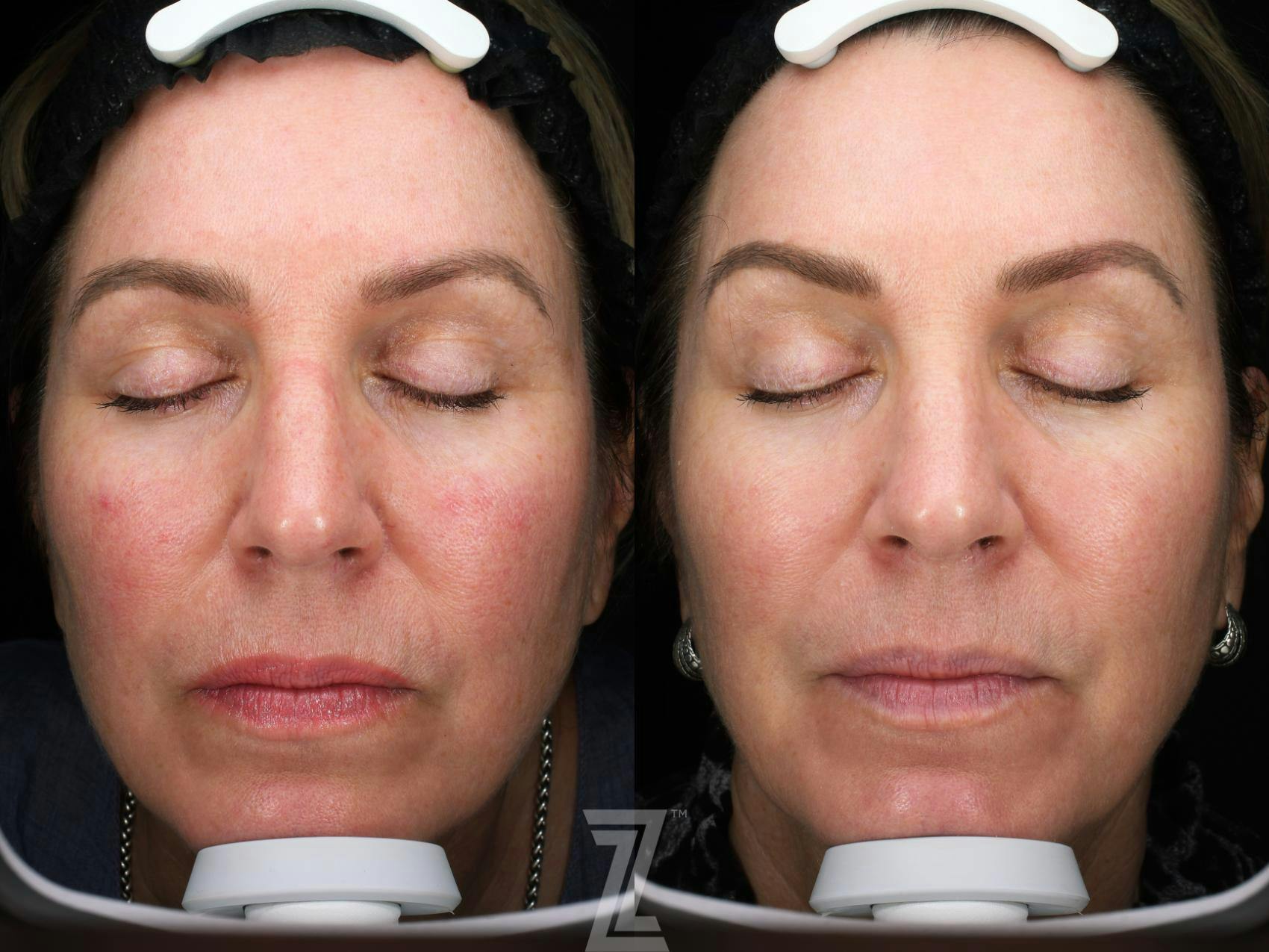 Visia Skincare Analysis Before & After Gallery - Patient 132963566 - Image 2