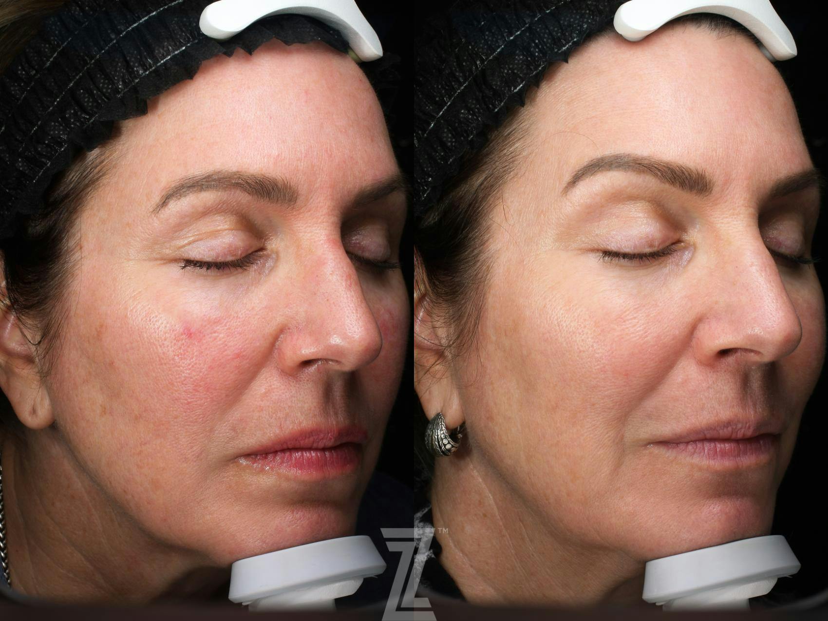 Visia Skincare Analysis Before & After Gallery - Patient 132963566 - Image 3