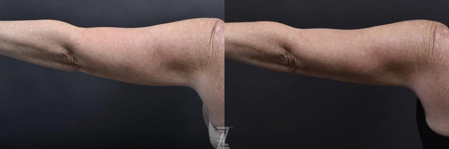 Profound® RF Microneedling Before & After Gallery - Patient 132963569 - Image 2