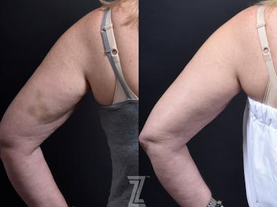 Austin Profound® RF Microneedling Before & After Gallery - Patient 132963577 - Image 1 - The Piazza Center