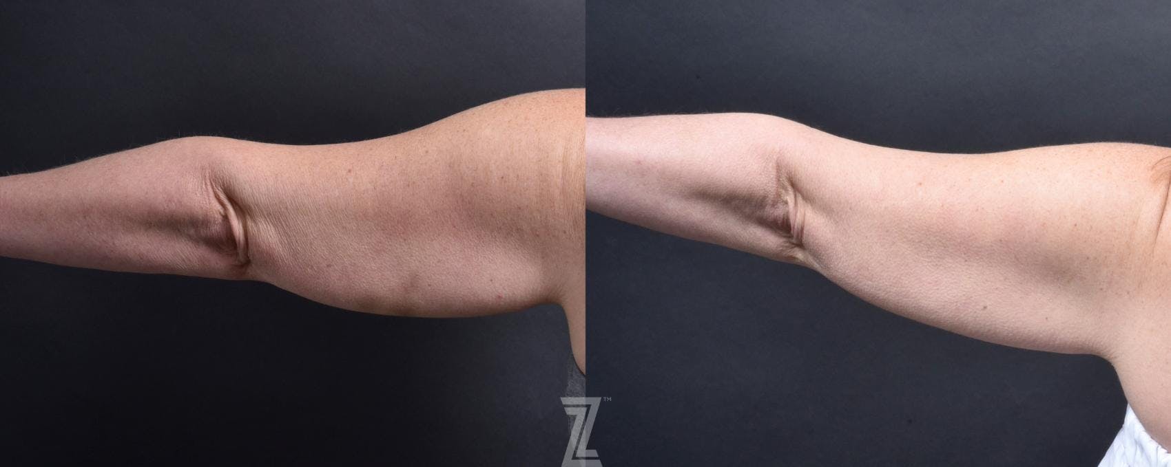 Profound® RF Microneedling Before & After Gallery - Patient 132963577 - Image 2