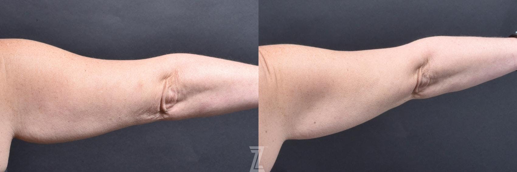 Profound® RF Microneedling Before & After Gallery - Patient 132963577 - Image 3
