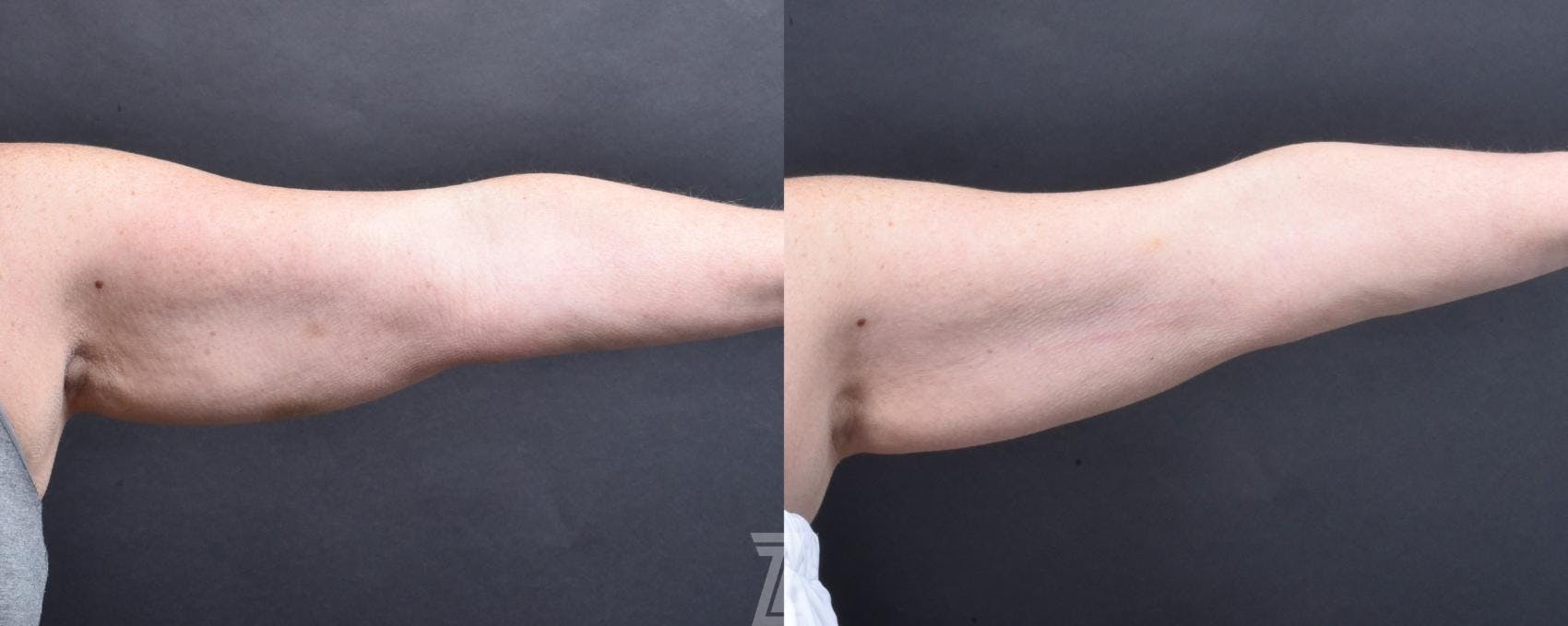 Profound® RF Microneedling Before & After Gallery - Patient 132963577 - Image 4