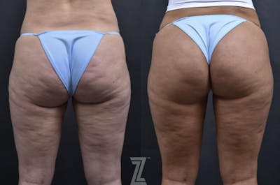 Austin Profound® RF Microneedling Before & After Gallery - Patient 132963580 - Image 1 - The Piazza Center