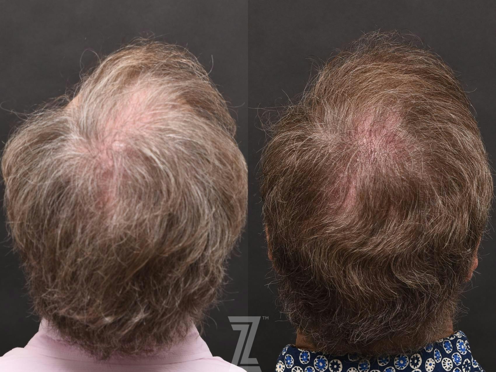 Hair Restoration Before & After Gallery - Patient 132963587 - Image 1