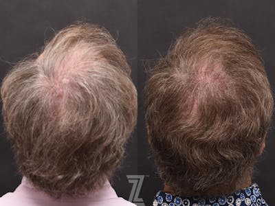 Austin Male Hair Restoration Before & After Gallery - Patient 336127 - Image 1 - The Piazza Center