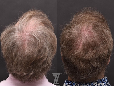 Hair Restoration Before & After Gallery - Patient 132963587 - Image 1