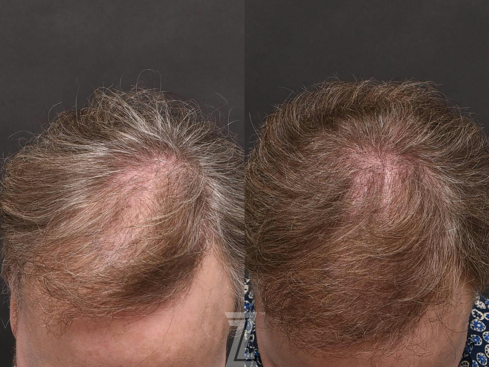 Hair Restoration Before & After Gallery - Patient 132963587 - Image 2