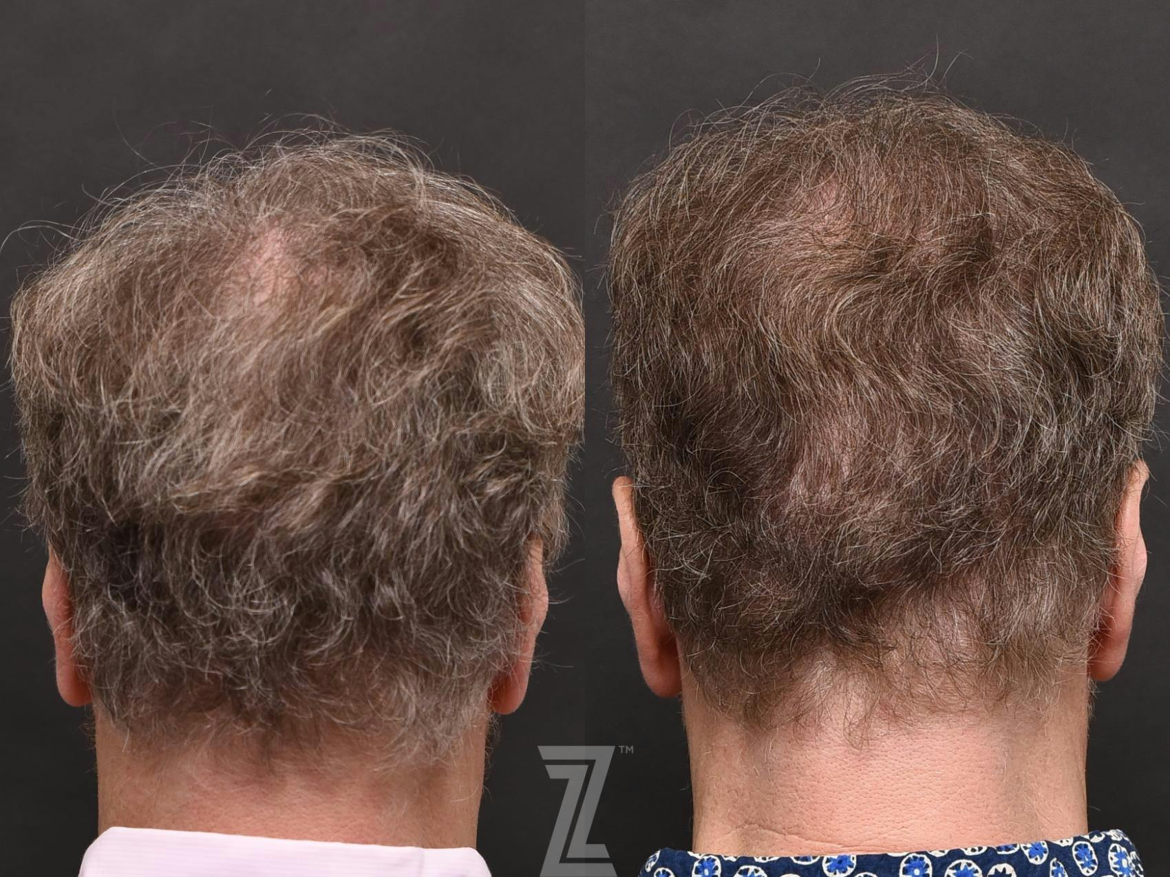 Hair Restoration Before & After Gallery - Patient 132963587 - Image 3