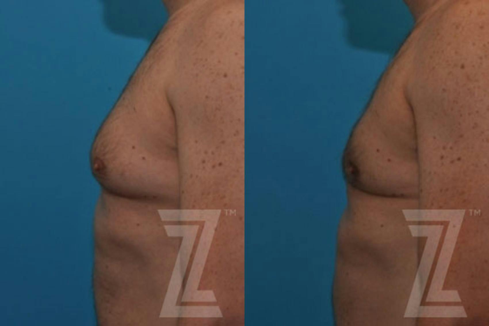 Male Breast Reduction Before & After Gallery - Patient 132963592 - Image 1