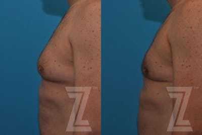 Austin Male Breast Reduction Before & After Gallery - Patient 132963592 - Image 1 - The Piazza Center