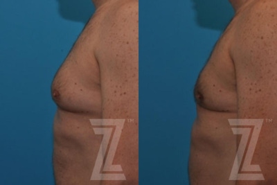 Male Breast Reduction Before & After Gallery - Patient 132963592 - Image 1