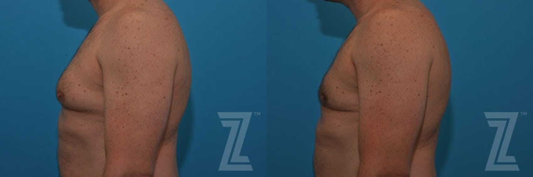 Male Breast Reduction Before & After Gallery - Patient 132963592 - Image 2