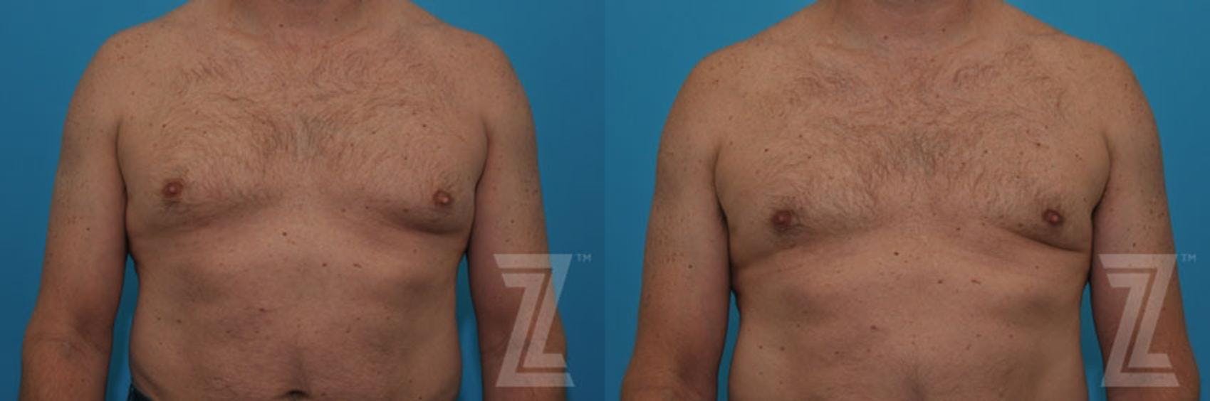Male Breast Reduction Before & After Gallery - Patient 132963592 - Image 3