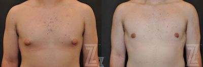 Male Breast Reduction Before & After Gallery - Patient 132963597 - Image 1