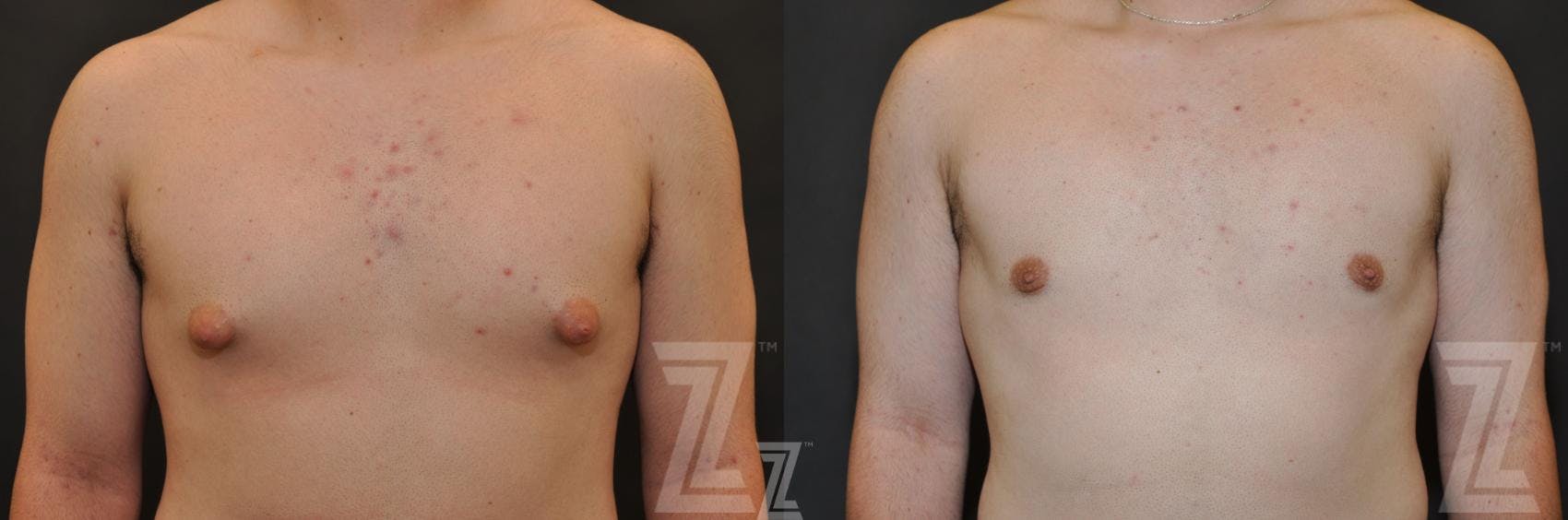 Male Breast Reduction Before & After Gallery - Patient 132963597 - Image 1