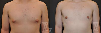 Austin Male Breast Reduction Before & After Gallery - Patient 132963597 - Image 1 - The Piazza Center