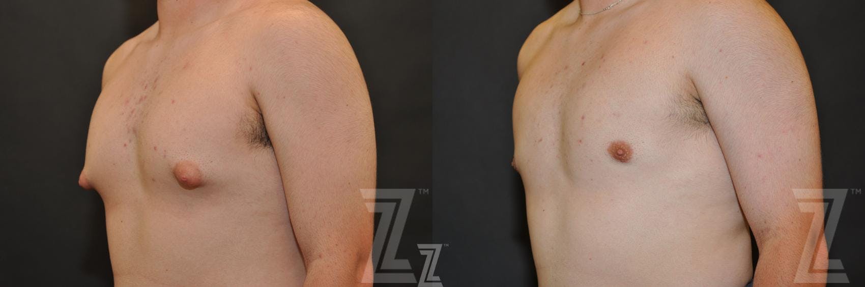 Male Breast Reduction Before & After Gallery - Patient 132963597 - Image 2