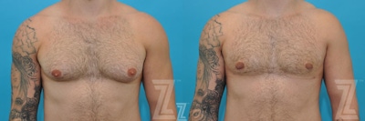 Male Breast Reduction Before & After Gallery - Patient 132963603 - Image 1