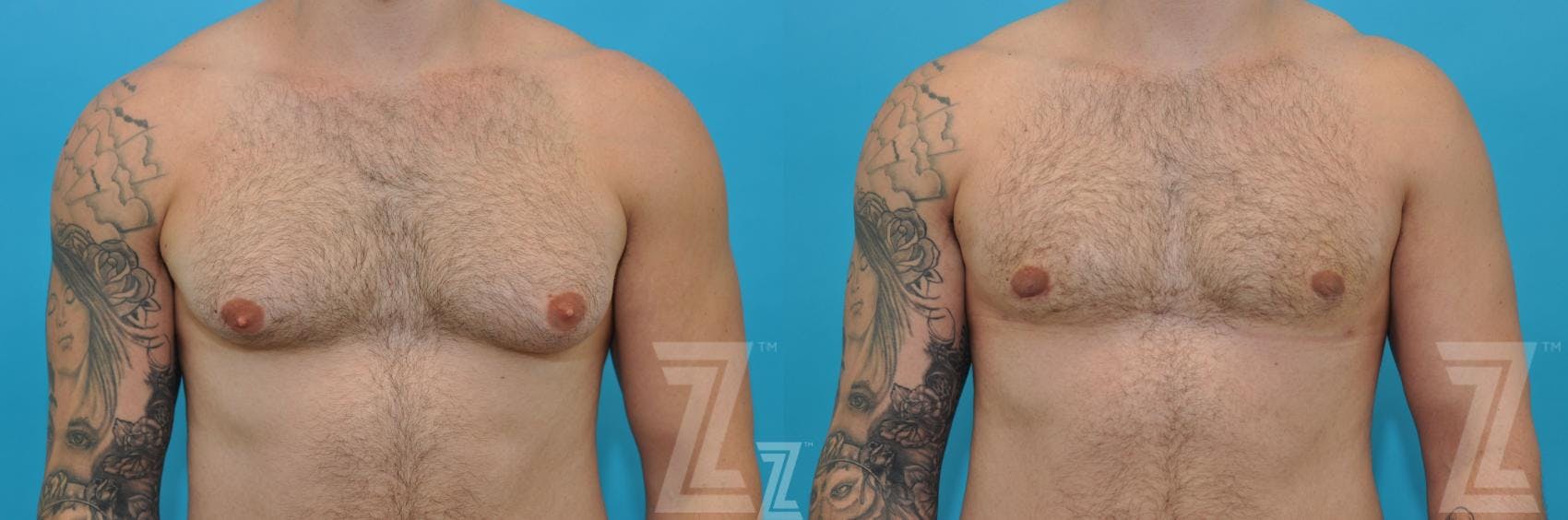 Male Breast Reduction Before & After Gallery - Patient 132963603 - Image 1