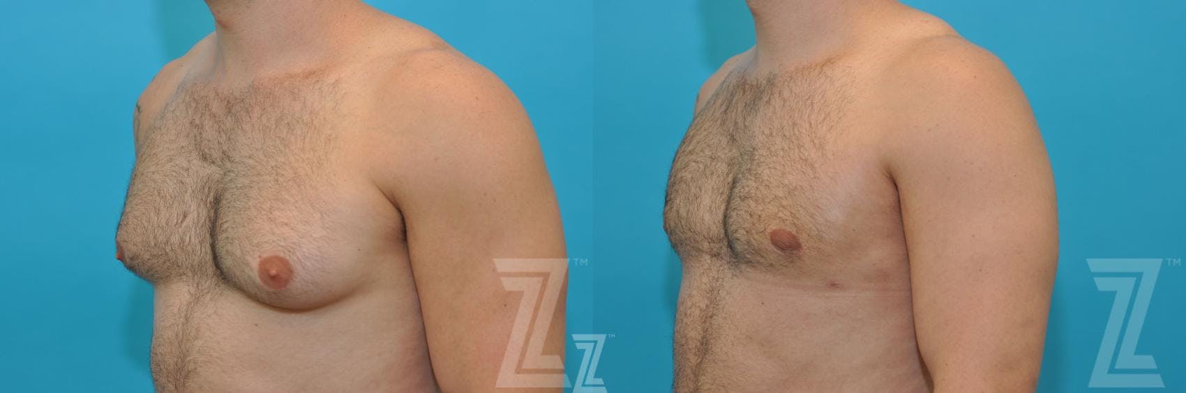 Male Breast Reduction Before & After Gallery - Patient 132963603 - Image 2