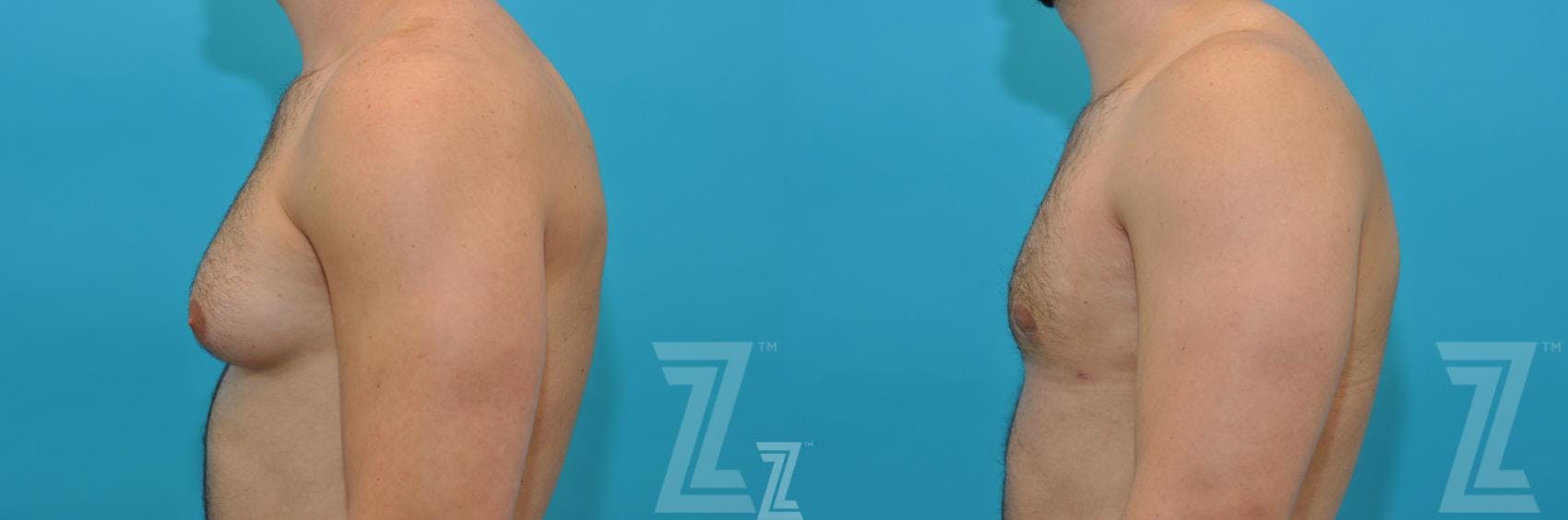 Male Breast Reduction Before & After Gallery - Patient 132963603 - Image 3