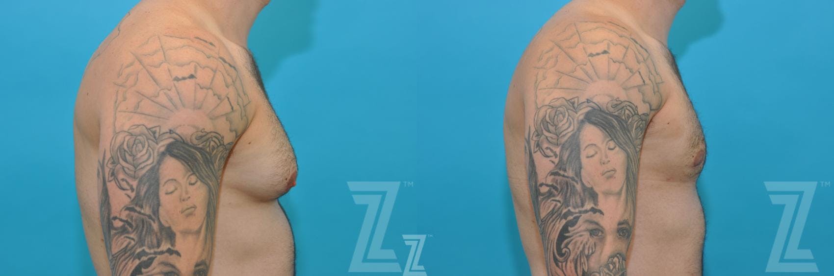 Male Breast Reduction Before & After Gallery - Patient 132963603 - Image 5