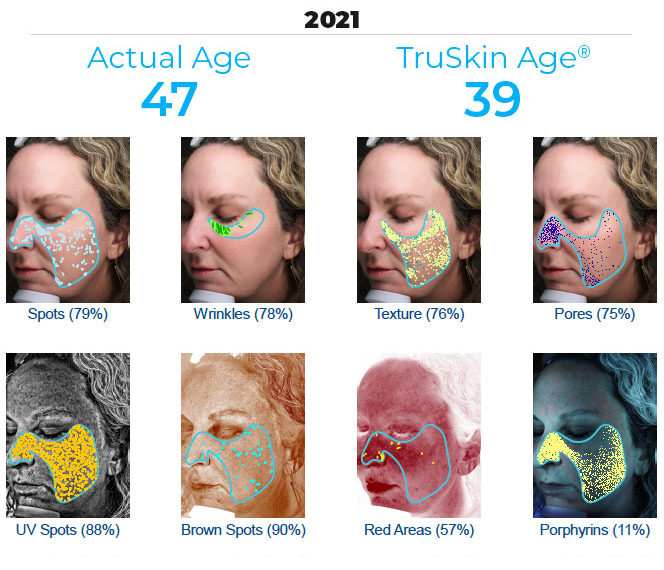 visia skin analysis