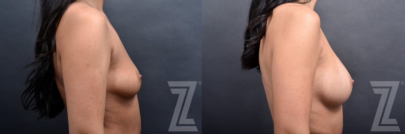 Breast Augmentation Before & After Gallery - Patient 191224114 - Image 3