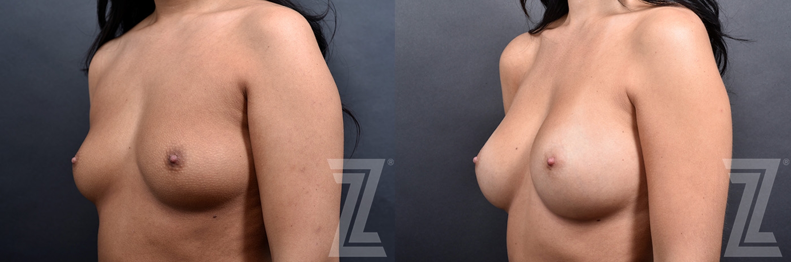 Austin 2 Years Post-Op Before & After Breast Augmentation in Austin, TX - Dr. Rocco Piazza - Oblique View - The Piazza Center