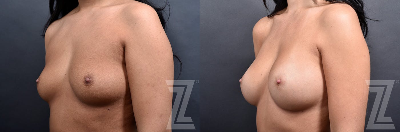 Breast Augmentation Before & After Gallery - Patient 191224114 - Image 4