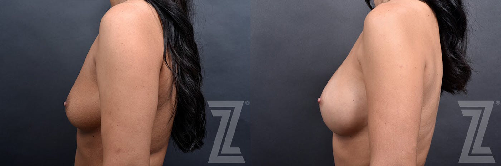 Austin 2 Years Post-Op Before & After Breast Augmentation in Austin, TX - Dr. Rocco Piazza - Lateral View - The Piazza Center